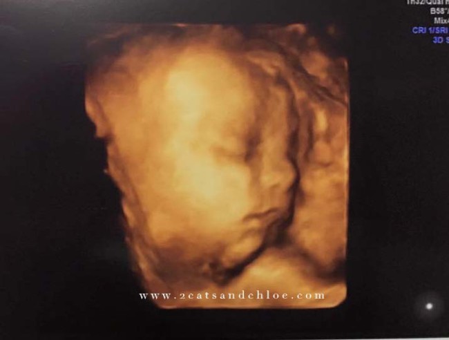 Loreleis ultrasound