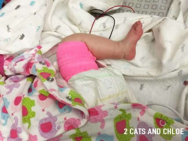 lorelei broken leg cast